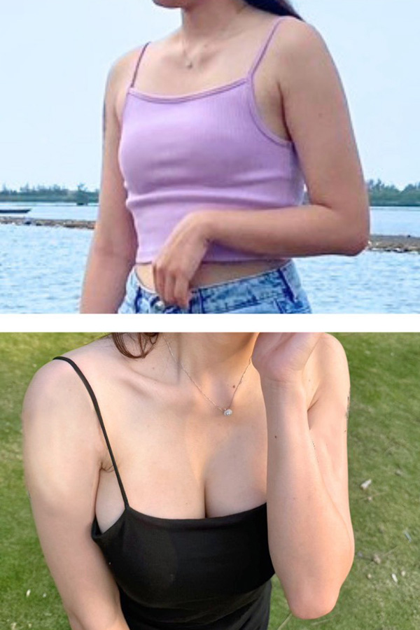 隆乳手術前後對比
