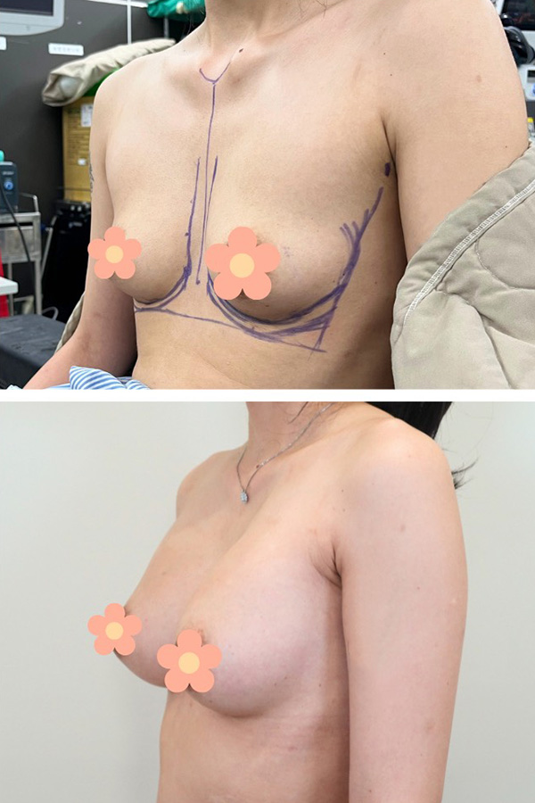 隆乳手術前後對比