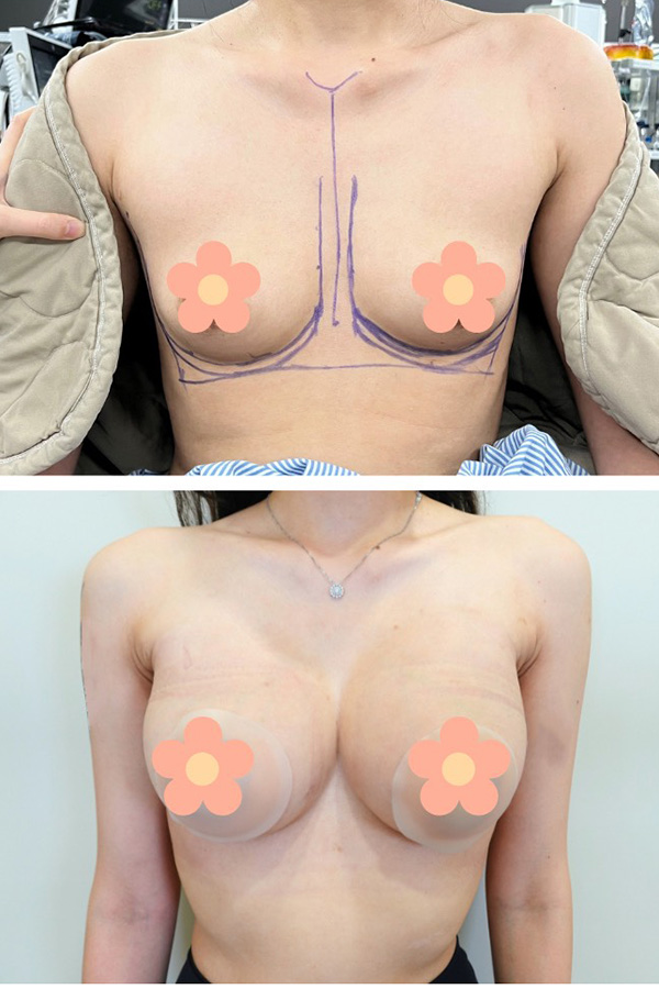 隆乳手術前後對比