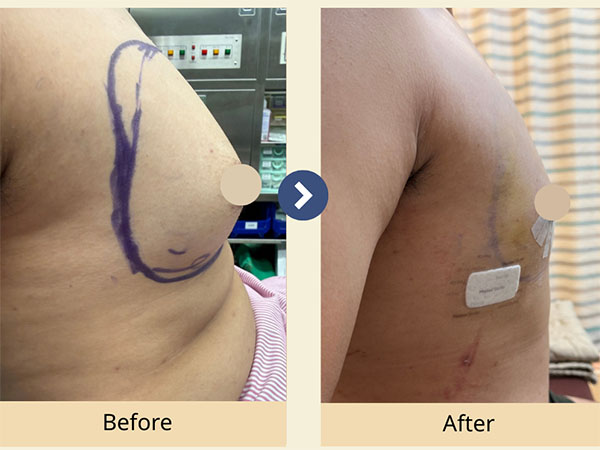 男性女乳症手術前後對照