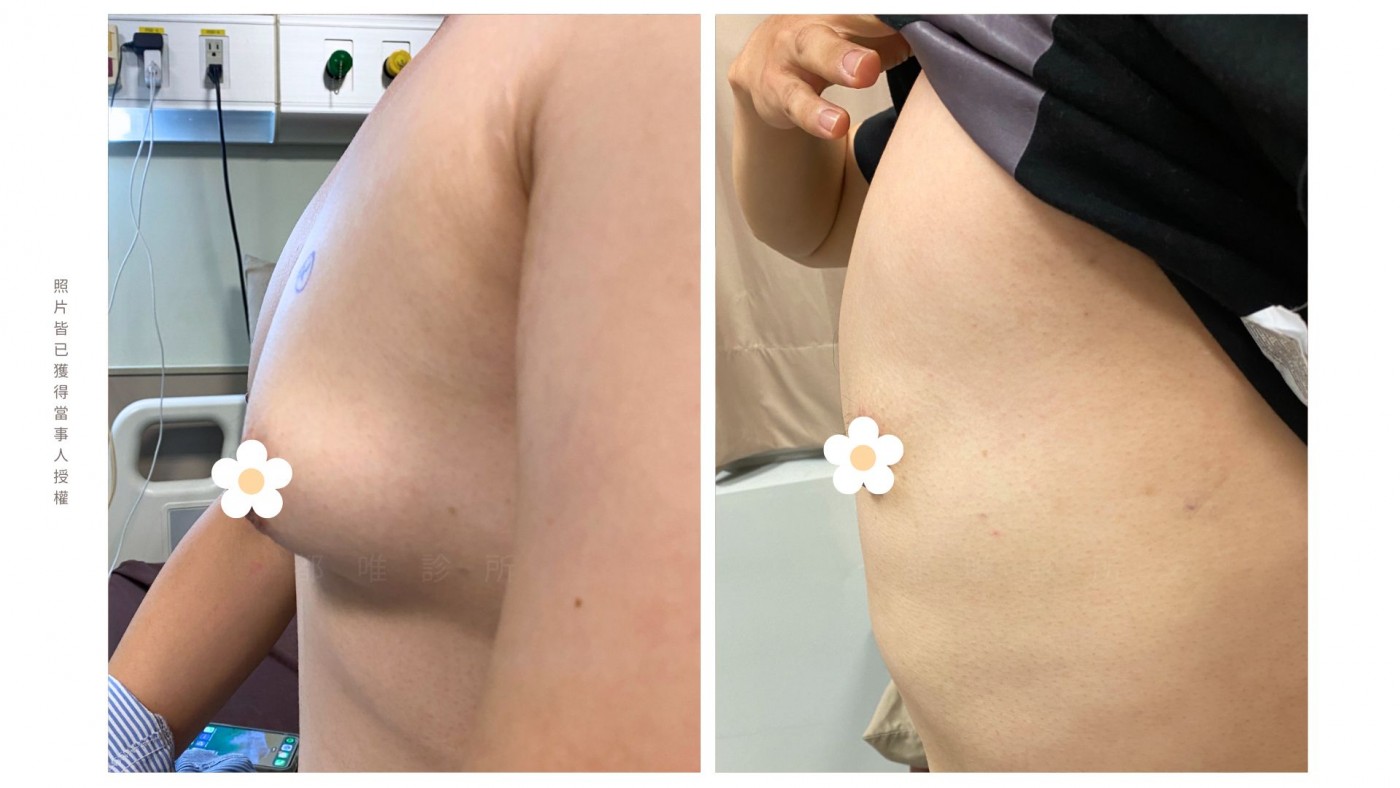 男性女乳症手術真實案例一・改善前後對照