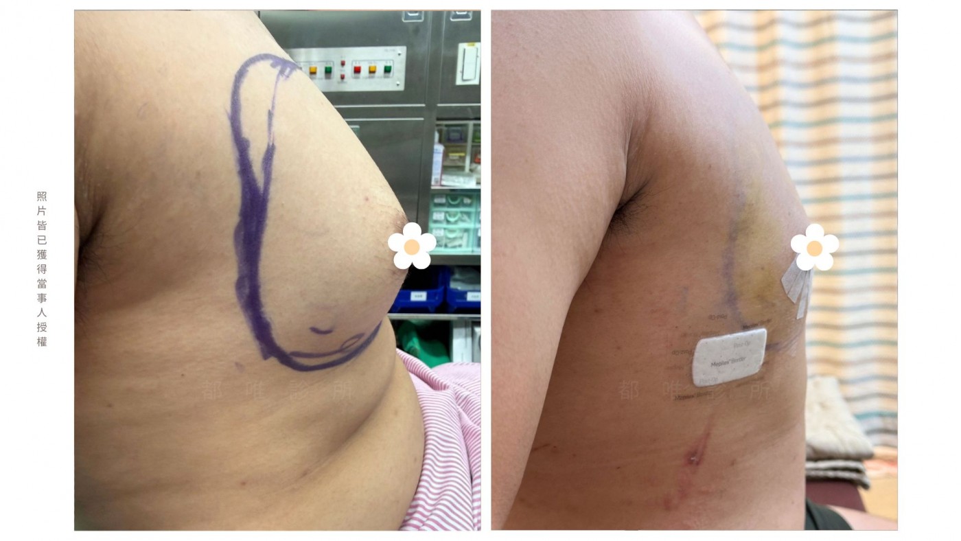 男性女乳症手術真實案例二・改善前後對照